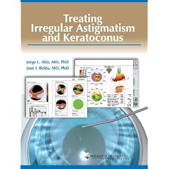 Treating Irregular Astigmatism and Keratoconus by Alio
