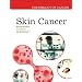 Skin Cancer (The Biology of Cancer)