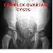 Complex Ovarian Cysts Complex Ovarian Cysts