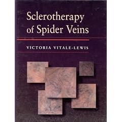 Sclerotherapy of Spider Veins by Victoria Vitale-Lewis