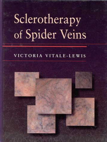 Varicose-Veins