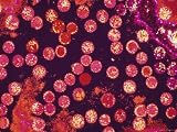 Sexually Transmitted Diseases Photographic Poster Print, 24x18