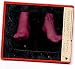1948 Medical Glass X Ray Science Gangrene Fee
