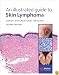 An Illustrated Guide to Skin Lymphoma