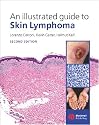 An Illustrated Guide to Skin Lymphoma