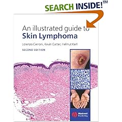 An Illustrated Guide to Skin Lymphoma