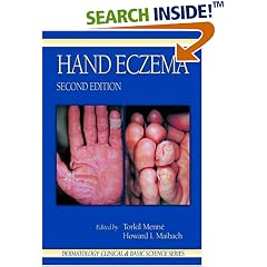 Hand Eczema (Dermatology)