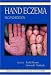   - Hand Eczema, Second Edition (Crc Series in Dermatology,)