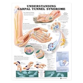 Carpal Tunnel Syndrome Chart