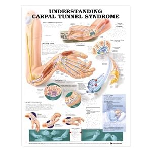 Understanding Carpal Tunnel Syndrome Anatomical Chart Plastic by Lake Forest Anatomicals Bone Joint Models