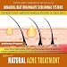 Natural Acne Treatment