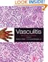 Vasculitis