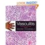 Vasculitis