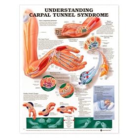 Click here to buy Understanding Carpal Tunnel Syndrome Anatomical Chart Laminated.