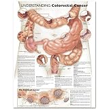 Understanding Colorectal Cancer Anatomical Chart (Laminated) 51SqQpAD6fL. SL160 Understanding Colorectal Cancer Anatomical Chart (Laminated)