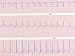 ECG Showing Sinus Tachycardia Photographic Poster Print, 16x12