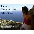 Lupus Causes, Symptoms, Signs, Diagnosis and Treatments
