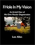 The Hole in My Vision: Watching My Own Age-Related Macular Degeneration