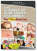 The7dayacnecure, The Scourge of Acne Under a Scanner
