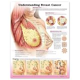Understanding Breast Cancer Anatomical Chart