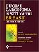 Ductal Carcinoma In Situ of the Breast