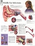 Middle Ear Infection, Paper Chart Scientific Publishing