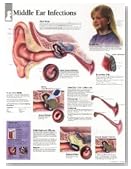Middle Ear Infection chart: Wall Chart