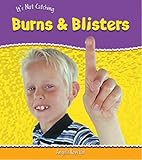 Burns & blisters