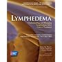 Lymphedema: Understanding and Managing Lymphedema After Cancer Treatment