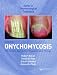 Onychomycosis, Second Edition (Dermatological Treatment)