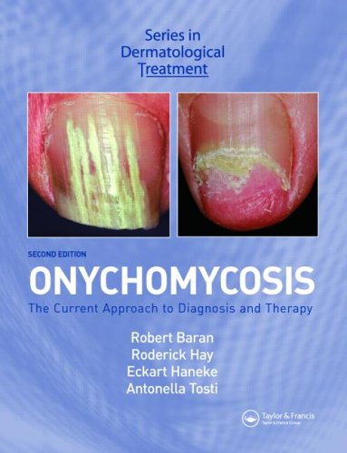 Onychomycosis: The Current Approach to Diagnosis and Therapy (Series in Dermatological Treatment) (French Edition)