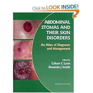 Click here to buy Abdominal Stomas and Their Skin Disorders: An Atlas of Diagnosis and Management by Calum C Lyon and Amanda J Smith.