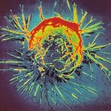 Breast Cancer Cell Gynecology Research Photographic Poster Print, 24x24