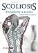 Scoliosis : straightening is possible (without brace or surgery)