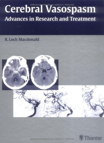 Vasospasm