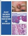 Atlas of Skin Cancers Processed by Frozen Sections and Mohs Surgery