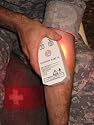 The Warp 10® is the Only Portable, Proprietary High Intensity Light Injury Treatment Unit which is FDA Cleared for Market in the Treatment of Chronic Pain, Developed with and Recognized By NASA and the Department of Defense and is currently in use by the U.S. Military for Battlefield Injury Treatment. Now Clinically Proven Effective for Wrinkle Reduction.