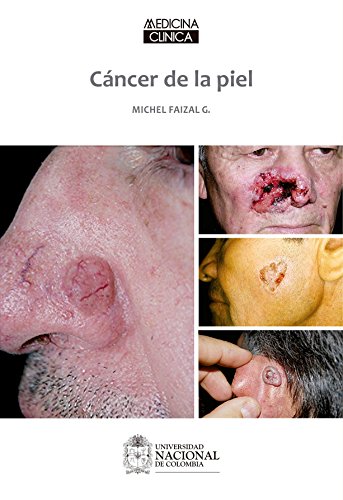 Cáncer de la piel (Spanish Edition)