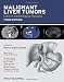 Malignant Liver Tumors: Current and Emerging Therapies 51XtZqbyU8L. SL75 Laparoscopic Liver Tumor Removal (#3)