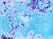 Color Enhansed Trichomonas Vaginal Protozoa Pap Smear Photographic Poster Print, 16x1...