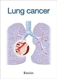 lung cancer treatment 