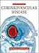  : Principles of Cerebrovascular Disease