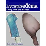 Lymphedema - Living with the disease