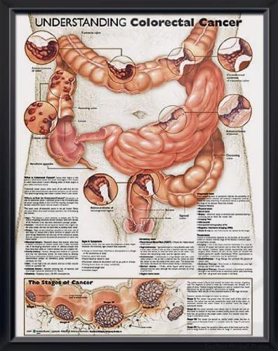 Understanding Colorectal Cancer, DeuPair 20x26" Pocket Frame Human Anatomy Poster