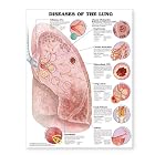 Diseases of the Lung Anatomical Chart by Anatomical Chart Company
