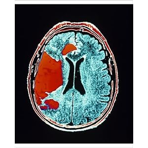 Stroke+ct+scan+images