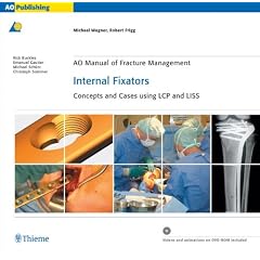 Internal Fixators: Concepts and Cases using LCP and LISS