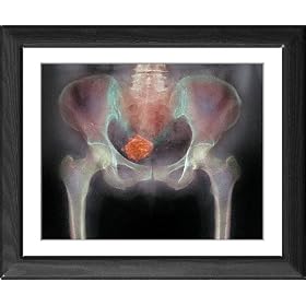 Framed Print of Uterine fibroid from Science Photo Library