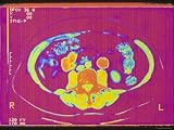 CT Scan, Abdomen 66 Year Old Woman Photographic Poster Print, 24x18