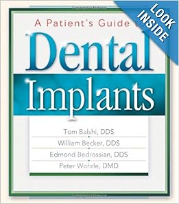 uide to Dental Implants: William Becker DDS, T